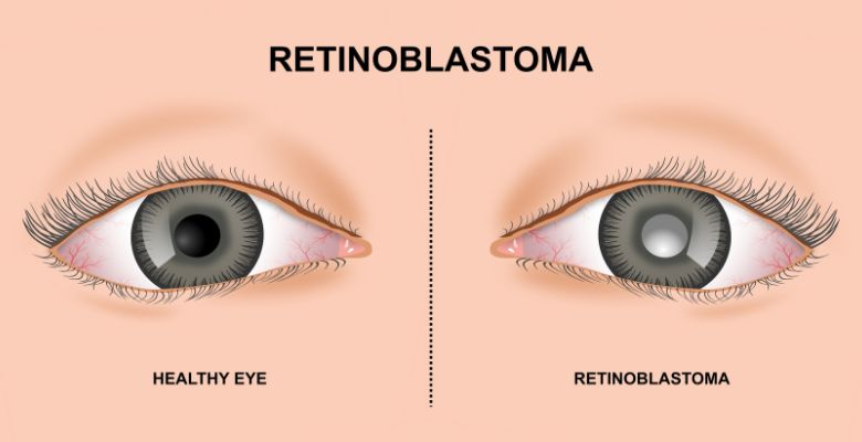 Olhar atento: 3% dos tumores pediátricos em Portugal são retinoblastomas